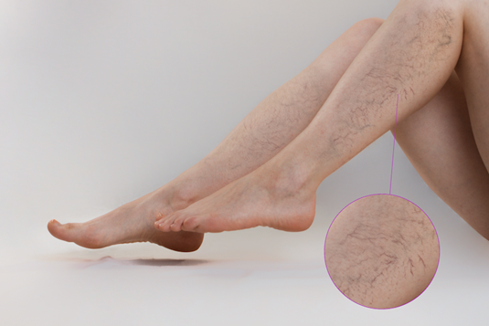 Giãn tĩnh mạch chân rất thường gặp ở phụ nữ sau sinh
