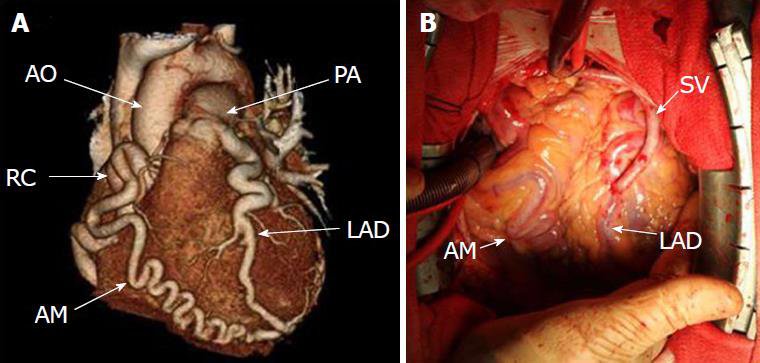 bất thường của động mạch vành trái từ động mạch phổi ở người trưởng thành