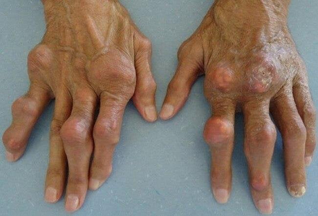 Bàn tay gout