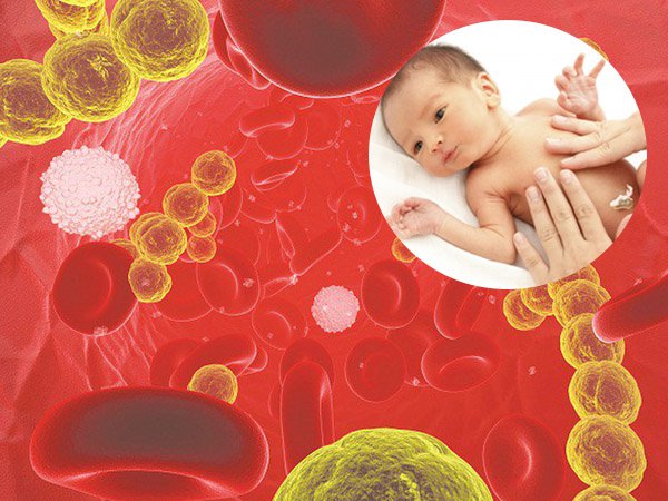Nhiễm trùng huyết là một trong những biểu hiện của nhiễm khuẩn sơ sinh