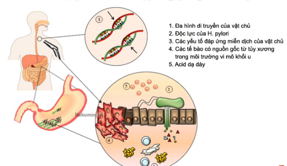 Mối liên quan giữa helicobacter pylori và ung thư dạ dày