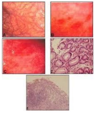 Hình ảnh mô bệnh học của viêm teo dạ dày