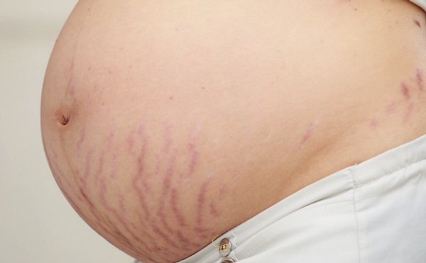 Tăng cân quá mức khi mang thai dẫn đến rạn da