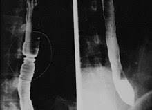 Hình ảnh X-quang của bệnh nhân bị VTQBCAT