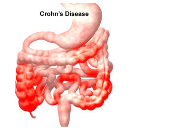 Bệnh Crohn
