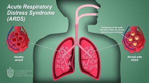 Acute Respiratory Distress Syndrome – ARDS