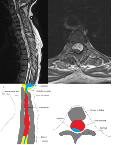 MRI cột sống ngực phần sagittal bên trái (mũi tên: giới hạn trên của schwannoma) và bên phải: phần sagittal ở độ cao của ngực 4 trước phẫu thuật