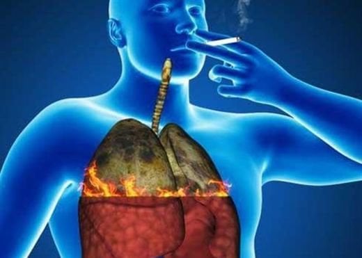 ung thư phổi nguyên phát