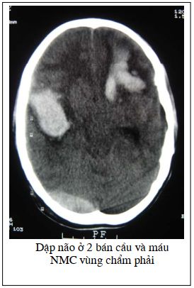 Chụp cắt lớp vi tính chấn thương sọ não