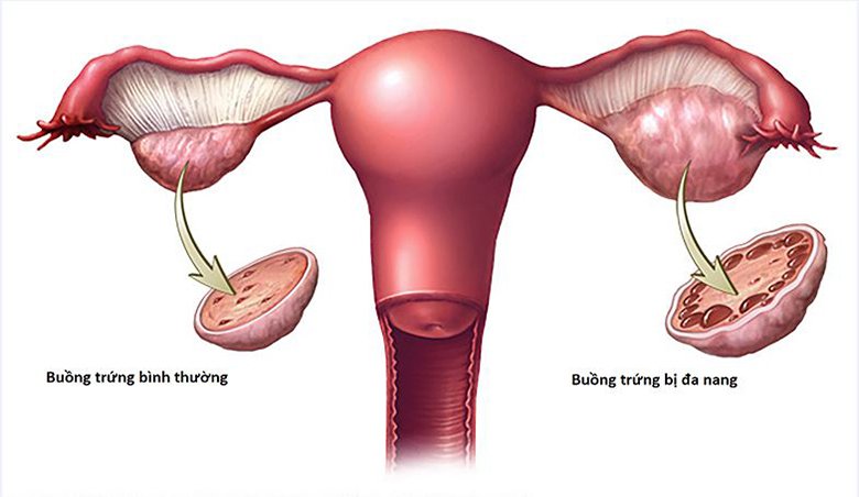 Hội chứng buồng trứng đa nang: Nguyên nhân, chẩn đoán, điều trị