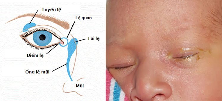 Hình ảnh tắc tuyến lệ ở trẻ sơ sinh