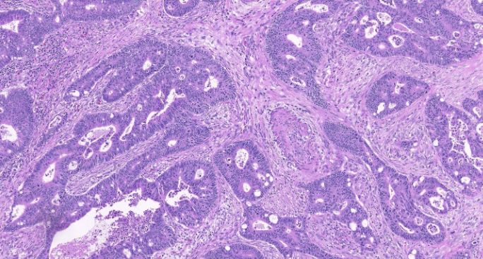 Hình ảnh tiêu bản ung thư biểu mô đại tràng rõ nét như trên kính hiển vi