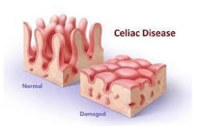 Hàng rào biểu mô niêm mạc bị phá vỡ gây ra các triệu chứng trong bệnh Celiac