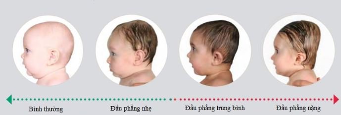 Hội chứng đầu phẳng ở trẻ sơ sinh