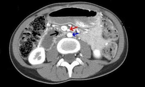 CT bụng và vùng chậu cho thấy: tá tràng bị chèn ép (mũi tên đen) giữa động mạch mạc treo tràng trên (mũi tên màu đỏ) và động mạch chủ bụng (mũi tên màu xanh).