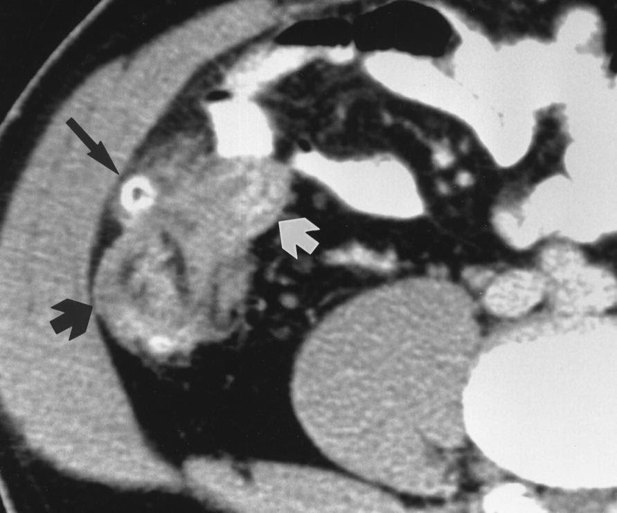 Hình ảnh CT của viêm túi thừa manh tràng
