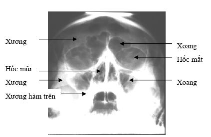 X quang sọ não
