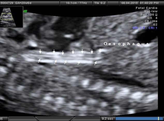 Thực quản đoạn bụng trên thai nhi 20 tuần 6 ngày dị tật thực quản
