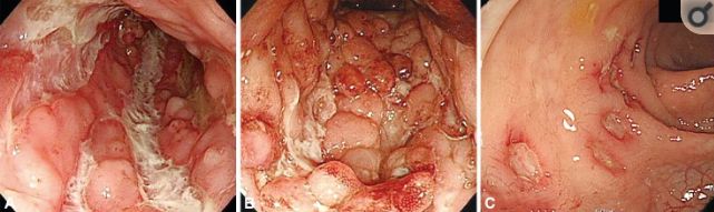 Đặc điểm nội soi điển hình của bệnh Crohn.