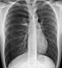 Tràn khí màng phổi dưới áp lực