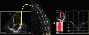 siêu âm sức căng cơ tim bằng phương pháp Speckle tracking