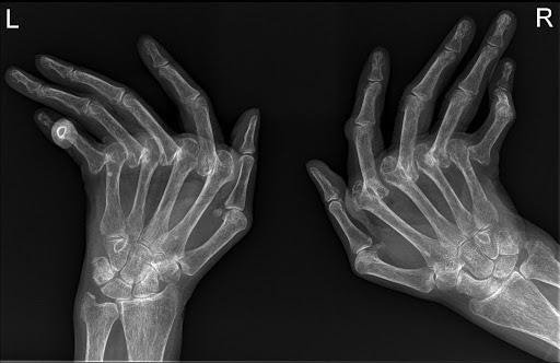 Kết quả chụp X-quang với hình ảnh các ổ viêm gây chệch khớp ngón tay