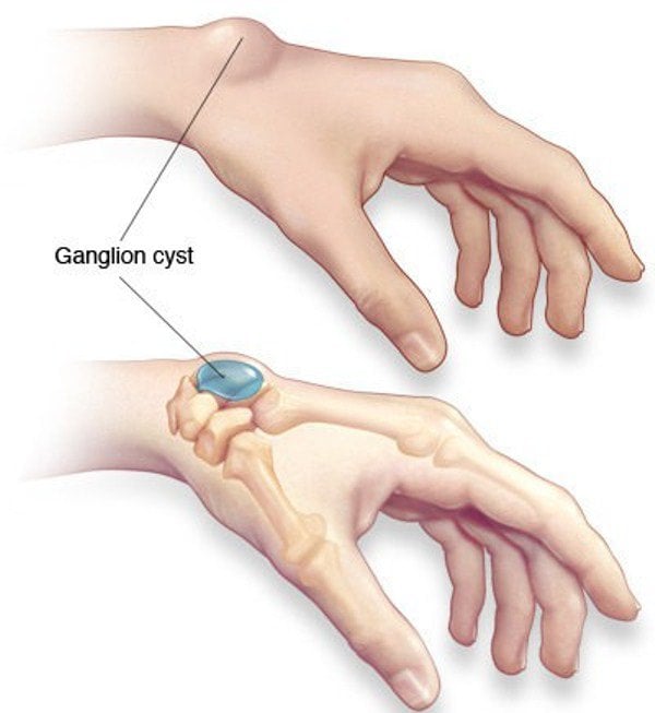 Bị u bao hoạt dịch khớp cổ tay tái phát có cách nào điều trị không?