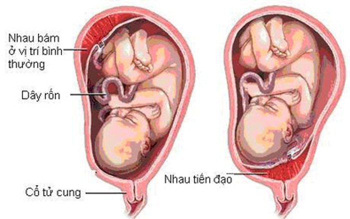 Nhau thai bám mặt trước độ III ở thai 35 tuần có sao không?