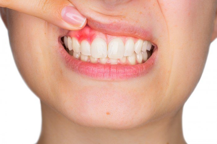 Phẫu thuật làm dài thân răng chỉ định cho người bị viêm nướu