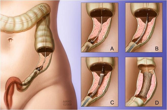 Một trường hợp tắc nghẽn được giải áp bằng stent