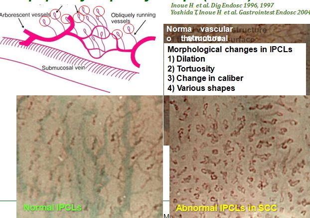 Hình 5: Hình ảnh các quai mao mạch trong ung thư thực quản
