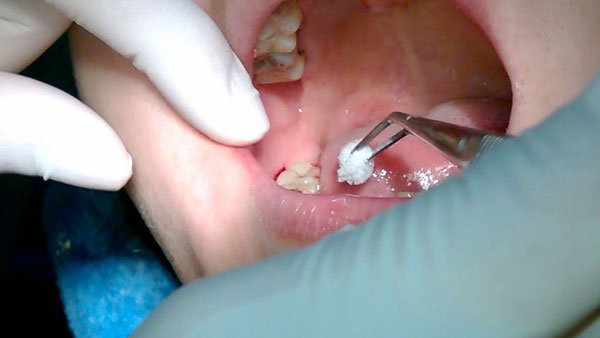 Nhổ răng khôn mọc lệch bằng phương pháp gây mê được không?