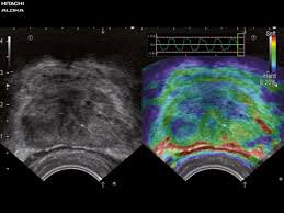 Real time elastography (RTE)