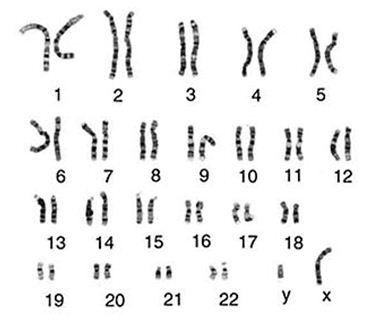 Trẻ xét nghiệm phát hiện  vi mất đoạn trên nhiễm sắc thể số 14 del(14)(q11,2) là sao?