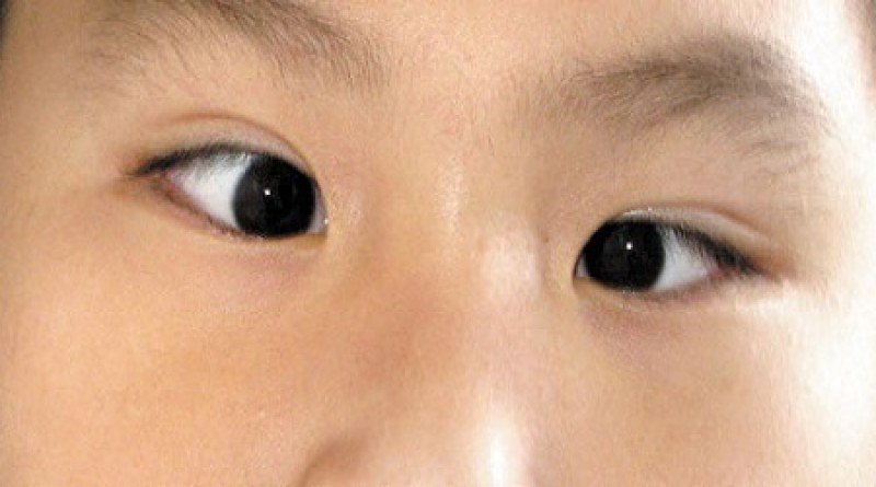 Lác nhẹ mắt trái sau phẫu thuật lác mắt là do đâu và điều trị thế nào?