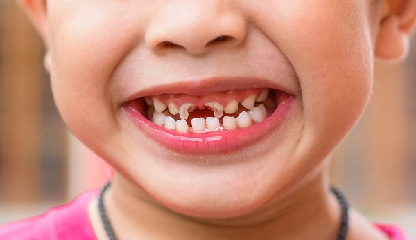Bé 3 tuổi bị mòn men răng gây sún có cách nào khắc phục được không?