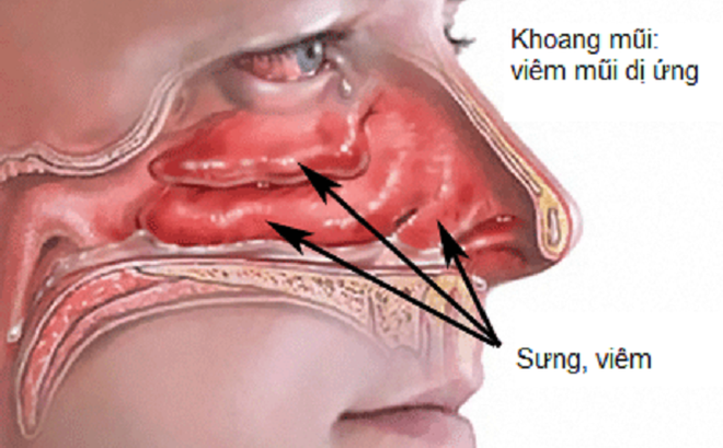 Phẫu thuật cắt u xơ vòm mũi họng bao lâu được xuất viện?