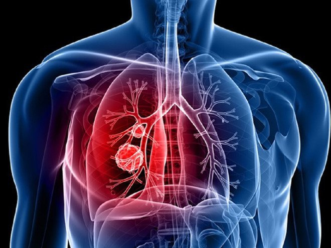 Hạch ở gần xương quai xanh to và đau do ung thư phổi giai đoạn 3B có thể mổ được không?