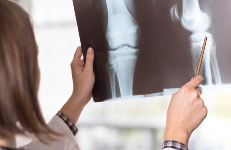 Chụp X quang có phát hiện thoái hóa khớp gối không
