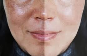 Đã sử dụng nhiều sản phẩm chăm sóc da và điều trị laser nhưng làn da không cải thiện nên làm gì?