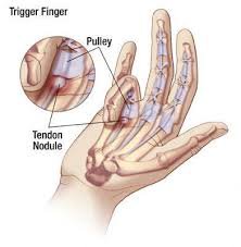 Sau phẫu thuật ngón tay cò súng ngón tay có trở lại bình thường được không?