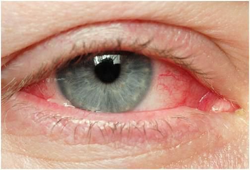 Đau mắt sau đo nhãn áp có chữa dứt điểm được không và có để lại di chứng không?