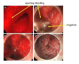 Hình ảnh chảy máu sau thủ thuật cắt niêm mạc điều trị ung thư sớm