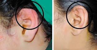 viêm màng sụn ở vành tai