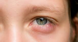 Sưng ở dưới mắt đã uống thuốc nhưng không đỡ là dấu hiệu của bệnh gì?