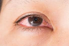 Nhỏ mắt có cảm giác hơi cay sau khi bị miệng chai chọc vào mắt có sao không?