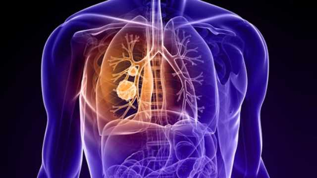 U ở cuống phổi nên điều trị theo phác đồ như thế nào?