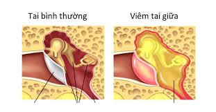 Cách điều trị hiệu quả viêm tai giữa thủng nhĩ và viêm tai xương chũm?