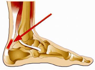 Điều trị đau gót Achille như thế nào để hồi phục nhanh nhất?