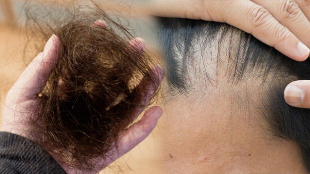 Trẻ bị rụng hết toàn bộ lông và tóc là dấu hiệu của bệnh gì?